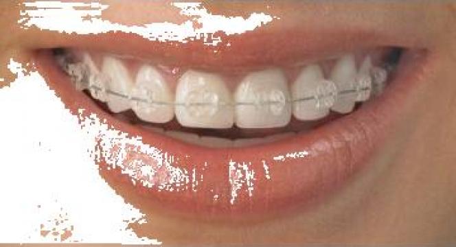Aparat dentar de la Medical Dental Blue Srl