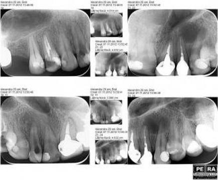 Radiografii dentare intraorale digitale pe film digital
